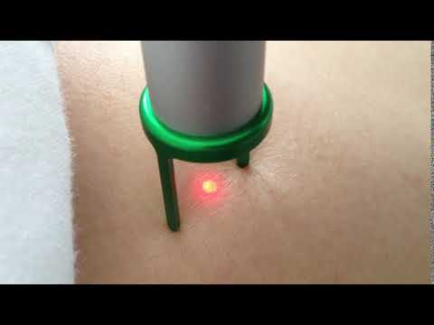 Laser Treatment, MedArt VariMed System