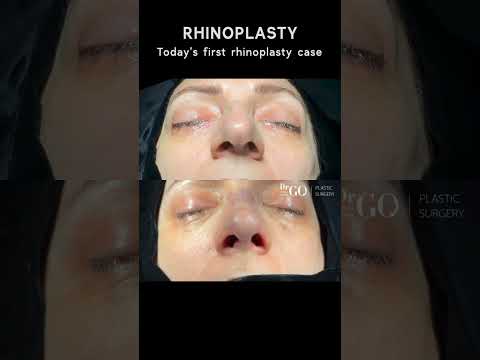 Patient Journey: Rhinoplasty Transformation with Surgery 🌟