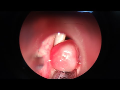 聲帶肉芽腫 接觸性肉芽腫 聲音沙啞 contact granuloma of vocal cord