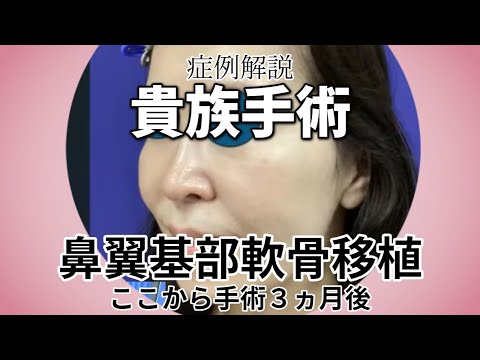 鼻翼基部軟骨移植、通称は貴族手術。手術後３か月の症例解説。名古屋こいずみ形成クリニック