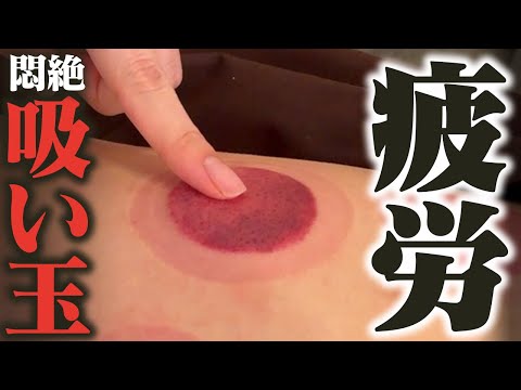 【吸い玉 慢性疲労】タカマナ先生のツンデレ吸い玉で院長の慢性疲労解消！悶絶ガラス吸い玉で院長が思わず…@はり灸整骨みのりの森治療院