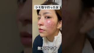 閲覧注意/548万回再生回数突破❗️シミ取り行った女