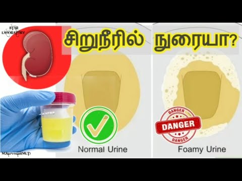 சிறுநீரில் நுரை வருகிறதா? | Foamy urine in tamil | urine foamy reason in tamil | STAR LABORATORY