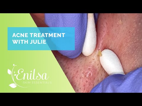 Acne Treatment & Extractions on Julie - New Patient!