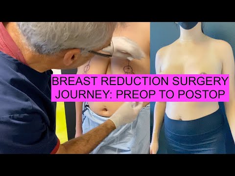 Full BREAST REDUCTION Surgery Journey aka MASTOPEXY from PREOP to POSTOP with Explanations!