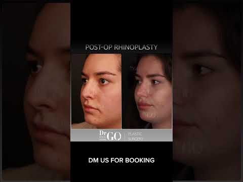 Before and after rhinoplasty operation - Dr Guncel Ozturk  #guncelozturk #drgo #burunestetigi