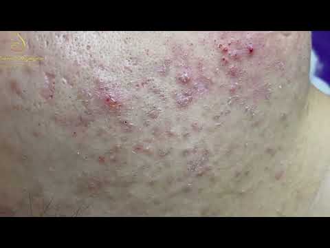 Loan Nguyen Acne Treatment 171e