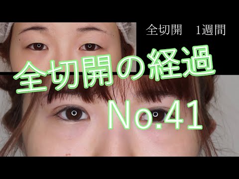 全切開（切開二重）のモニター様経過　41