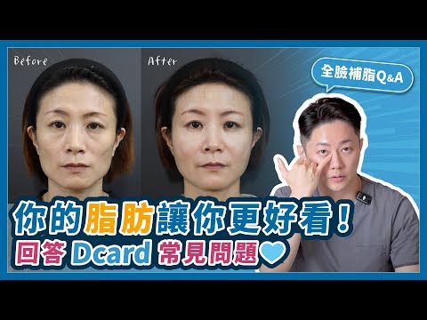 「全臉補脂」你的脂肪讓你更好看！回答Dcard常見問題💙｜台南杰美學 周杰醫師