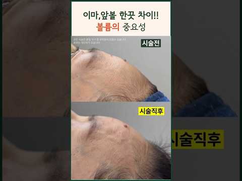 얼굴 볼륨의 중요성!! 앞볼 옆볼 이마 관자 꺼짐 채우기 #modsclinic #필러