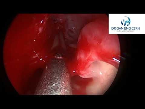 Revision (redo) sinus surgery (Frontal sinus)