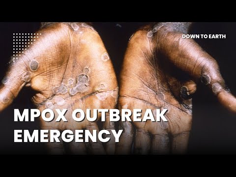 WHO terms latest upsurge of mpox ‘extraordinary’