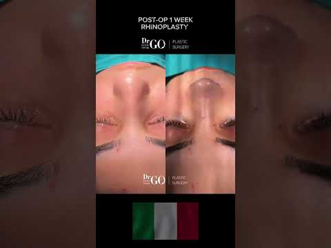 Before and After Rhinoplasty - Dr Guncel Ozturk  #drgo #guncelozturk #burunestetigi #burun