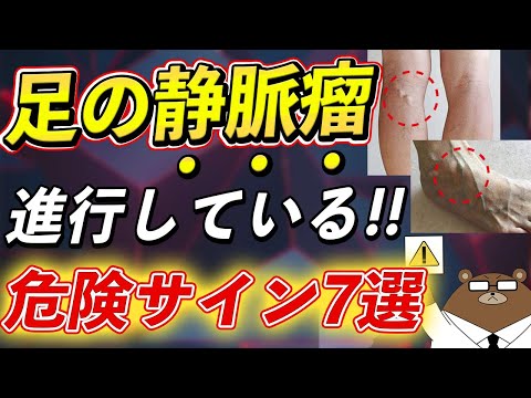 これって「下肢静脈瘤」!?放置するとどうなる!?絶対に知っておきたい足のミミズ血管が引き起こす7つの症状とは？予防法とは？