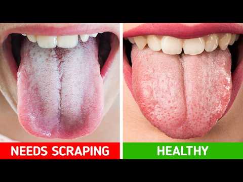 How to Cure Candida Naturally | 5 Home Remedies for Candida.