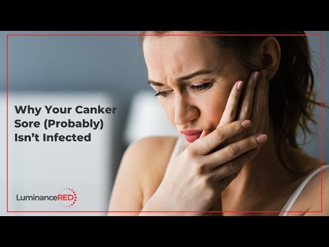 Why Your Canker Sore (Probably) Isn’t Infected