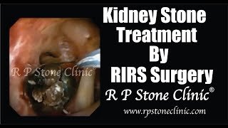 kidney stone treatment by RIRS Surgery