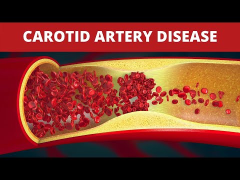 Treatment of Carotid Artery Disease