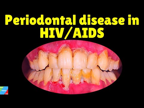 Periodontal Disease | Gum Disease | Periodontal Disease in HIV/AIDS | Oral Manifestation of HIV/AIDS