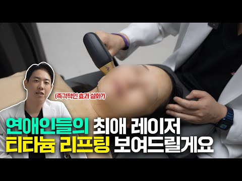 티타늄리프팅 1회 효과 직접 보여드리겠습니다 / 티타늄리프팅 실제 시술 후기!