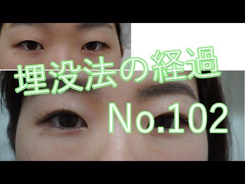 埋没法102　2点止め（2ループ止め）　2回目の埋没法ので一重まぶたから幅の狭い末広二重へ