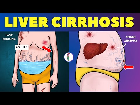 Liver cirrhosis - Warning Signs 🔥 Don't ignore these Red Flags | Chronic Liver Disease | Fatty Liver