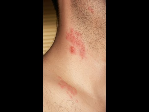 Shingles: Symptoms and Treatment. #Shorts