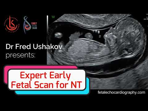 NT expert: Scanning and Management of the Fetus with Increased Nuchal Translucency - 2021