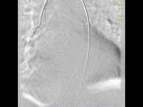 Rupture of descendent thoracic aorta:Endovascular management