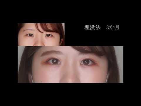 埋没法の経過　幅広末広型の二重　#shorts