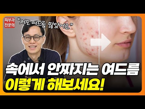 피부속 짤수 없는 여드름, 어떻게 해야되나요⁉ | 여드름 없애는법, 여드름치료