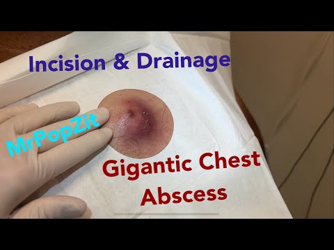 Giant inflamed abscess on chest. Incision & drainage. So much inside that comes out! Pressure relief