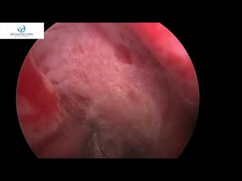 Left epistaxis (nosebleed) stopped under general anaesthesia