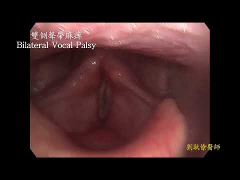 雙側聲帶麻痺 聲音沙啞 阻礙呼吸 bilateral vocal palsy hoarseness dyspnea