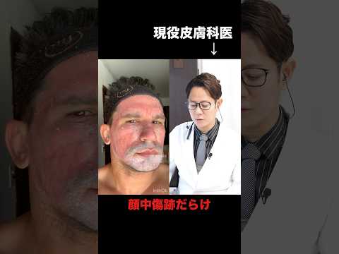 Phenol peeling: Japanese People Also Undergo This Treatment?