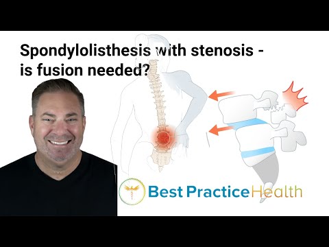 Is fusion necessary for the treatment of spondylolisthesis with stenosis? | Best Practice LIVE