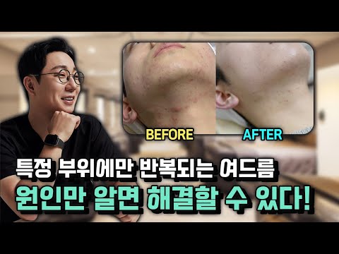 오가나셀 피부과만의 여드름 피부 관리 방법은?│턱여드름치료