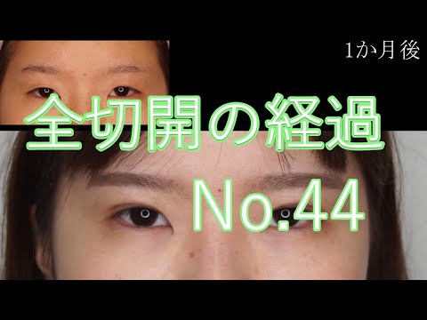 全切開二重手術　44