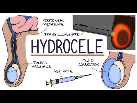 Understanding Hydroceles