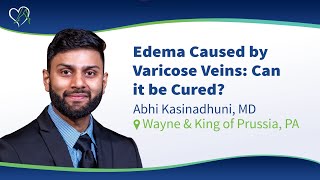 Edema Caused by Varicose Vein Disease: Can it be Cured?