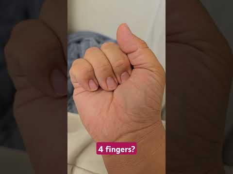 What happened to the last finger?