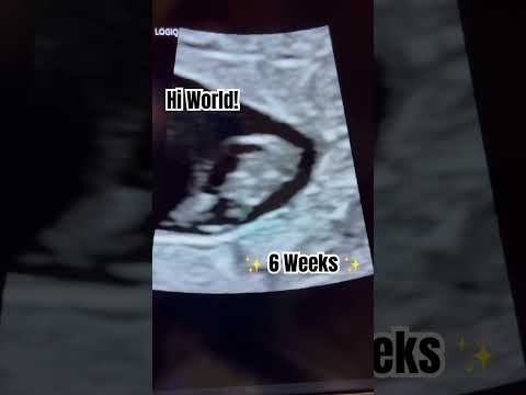 6 weeks pregnant scan #ultrasound