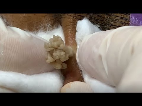 Very Big And Deep Acne | Milia Acne 2019