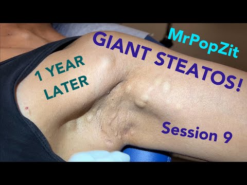 Giant Steatos Part 9! The biggest Steatocystomas you have ever seen. Steato abscess,Steatos on veins