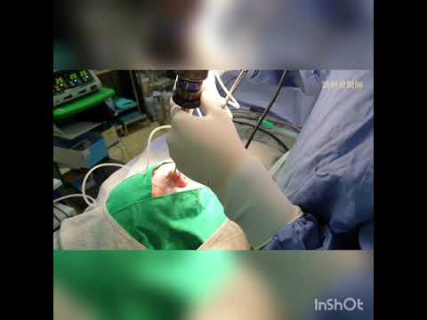 耳咽管氣球擴張術 Balloon Tuboplasty