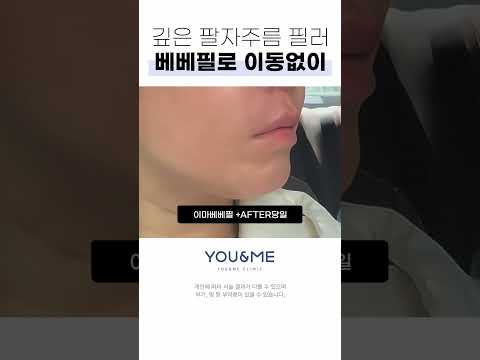 푹 패인 팔자주름을 촘촘하게 매꿔주는 필러 #베베필