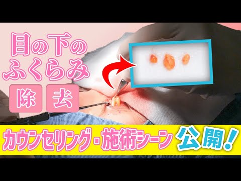 【目の下のたるみ取り】下眼瞼脱脂術の施術シーンを大公開します！！