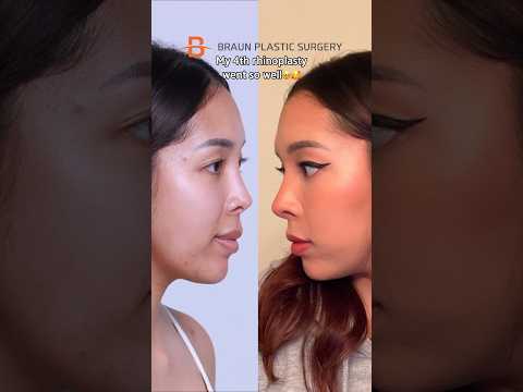 The before&after in the end of the video🤩 #revision #rhinoplasty #nosejob