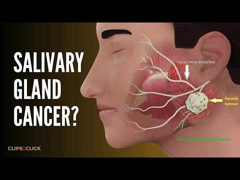 Salivary Gland Cancer: Symptoms, Causes, & Treatment Options