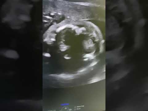 Normal head fetus #health #ultrasound #sonographer #ultrasoundtech #science #pregnancy #baby